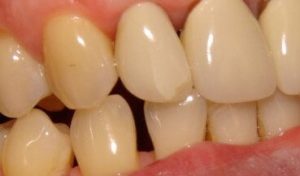Close-up photo of the upper right lateral incisor crown, showing the cracks forming in the porcelain.  If you take away the crack, it was really quite a good looking crown!