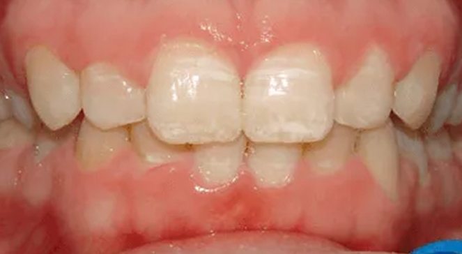 Close-up of teeth with natural translucency