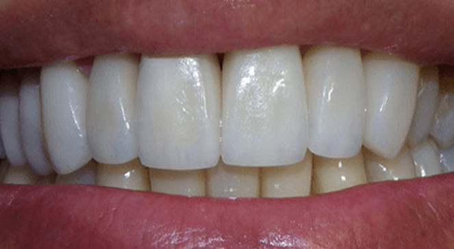 Smile showing even front teeth