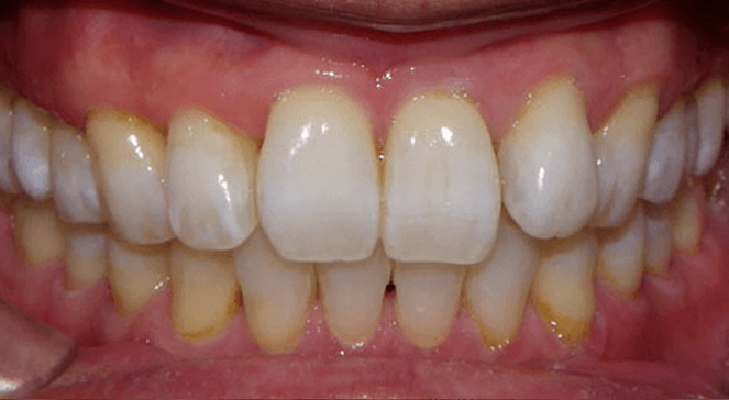 Close-up of teeth showing uniform shade