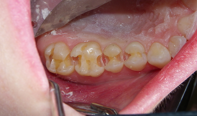Lower teeth showing alignment and gum health