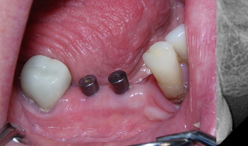 Close-up of lower teeth and gums