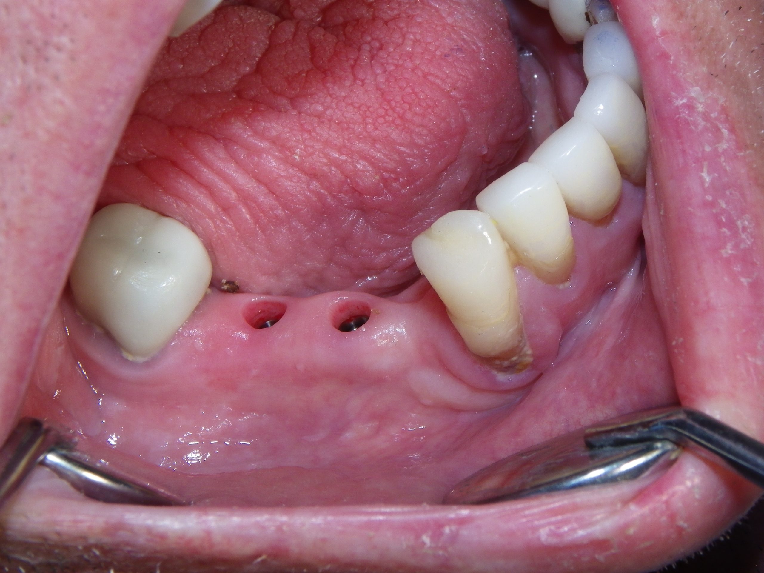 Dental arch view showing natural tooth spacing