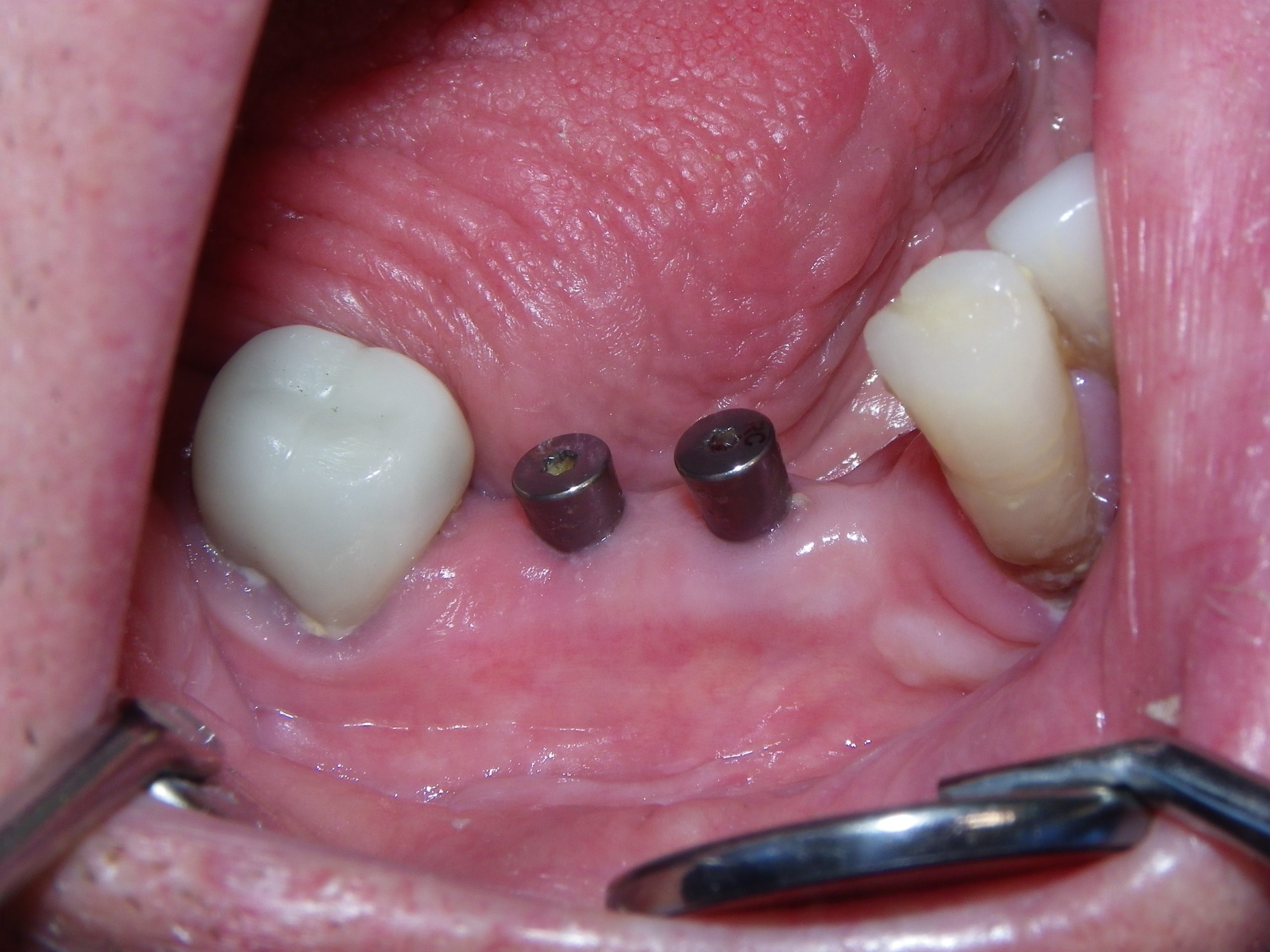 Close-up of dental implant posts in lower jaw