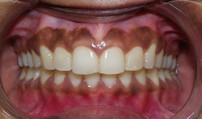 Smile with bright, uniform teeth