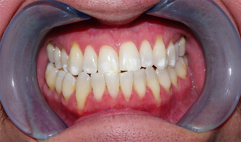Smile showing restored front teeth