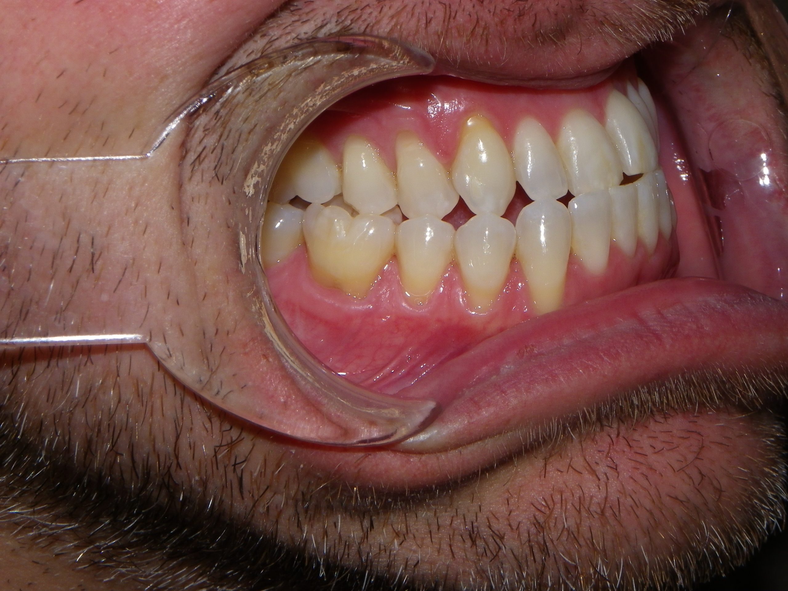 Patient smile showing natural teeth and gums