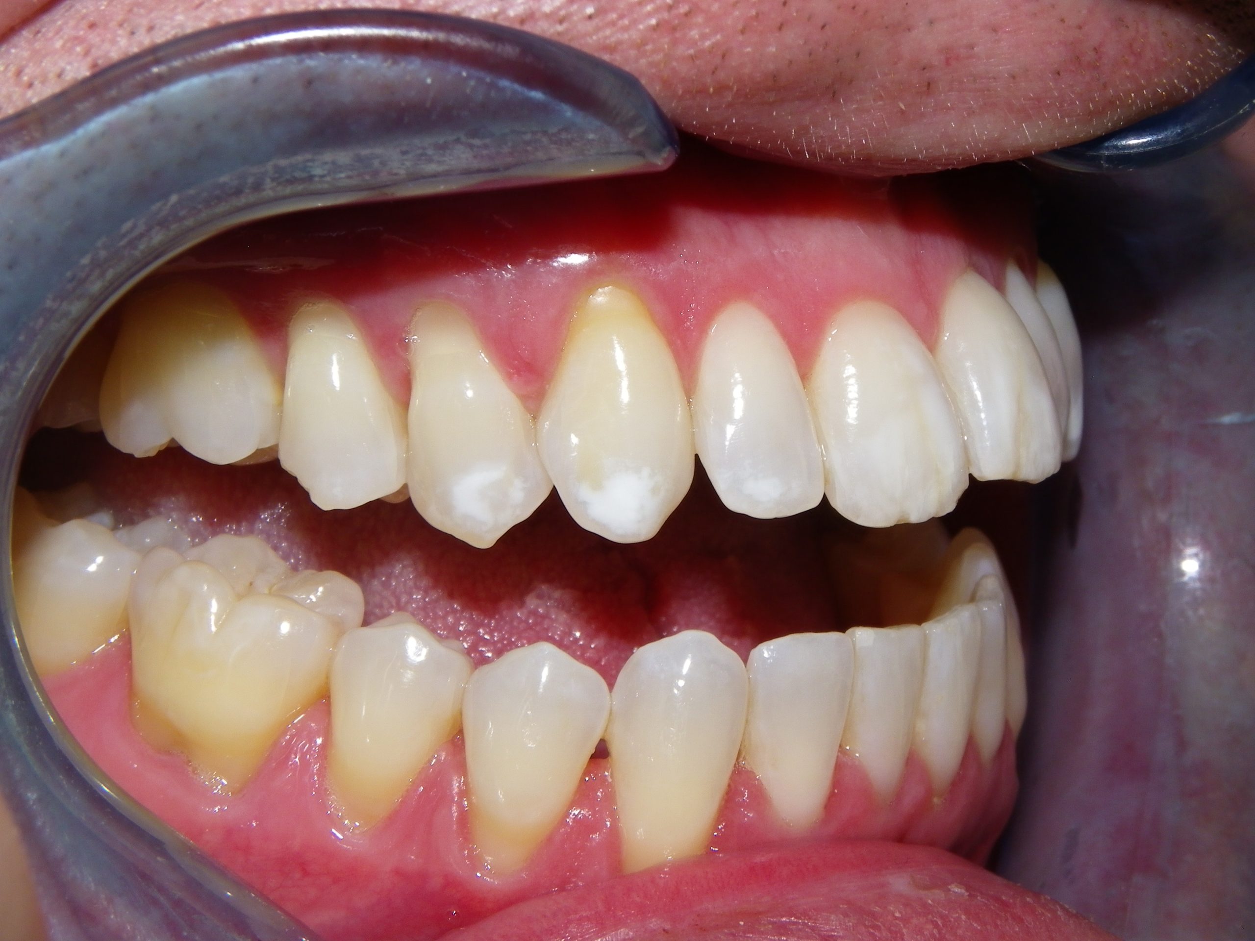 Intraoral image showing molars and gum health