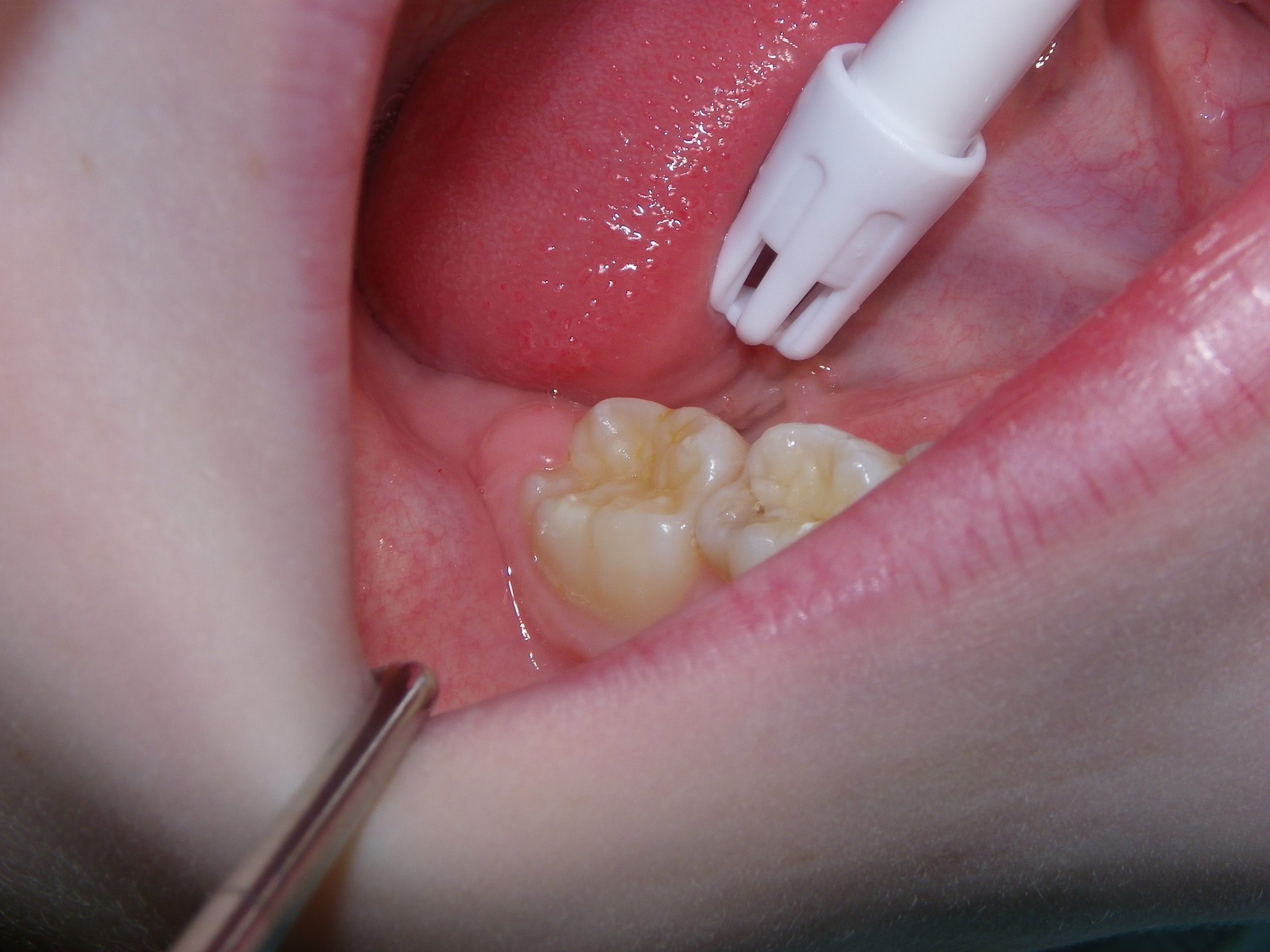 Close-up of molar during dental treatment