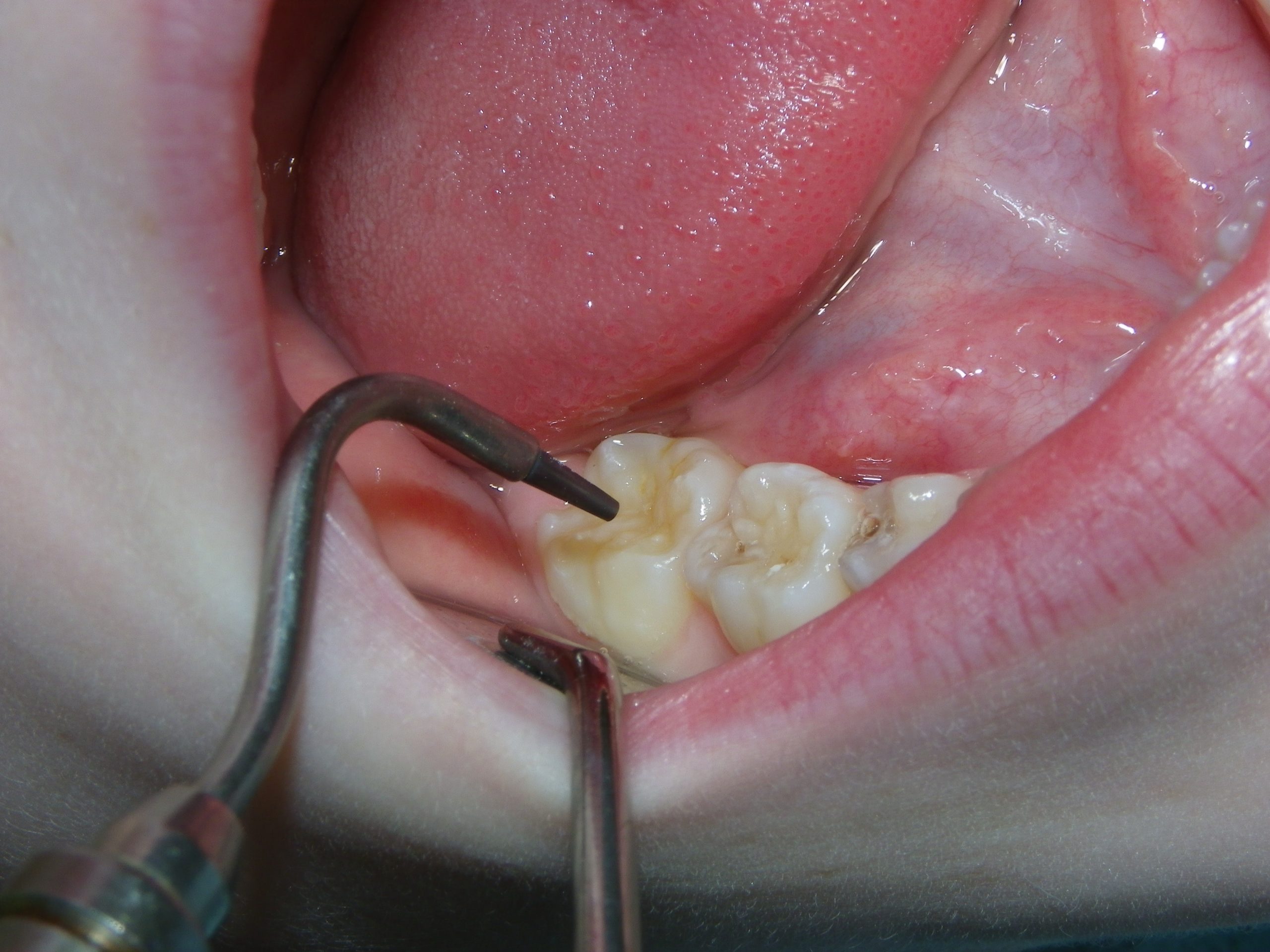 Intraoral dental procedure showing tooth restoration