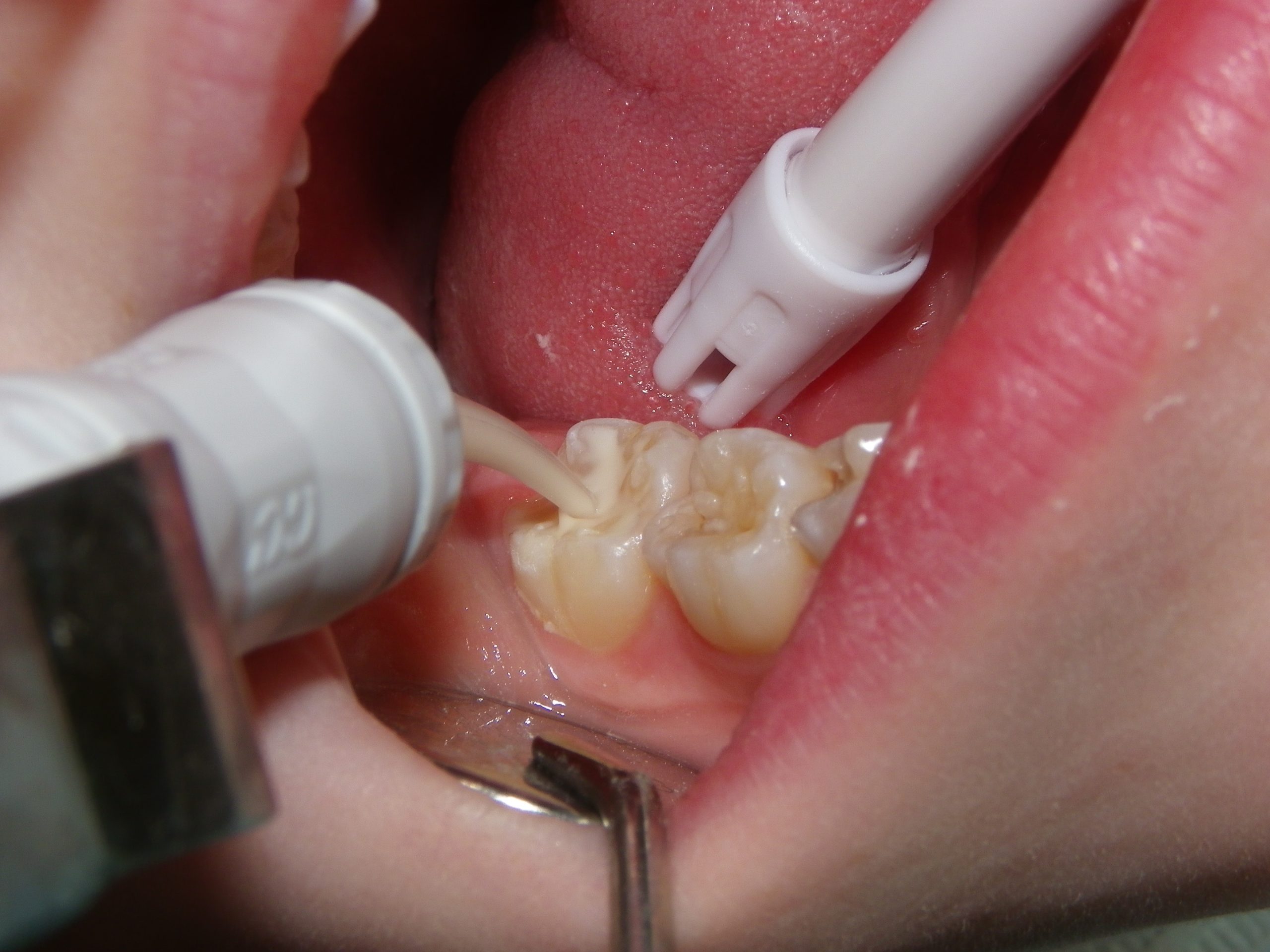 Dental instrument treating molar tooth surface