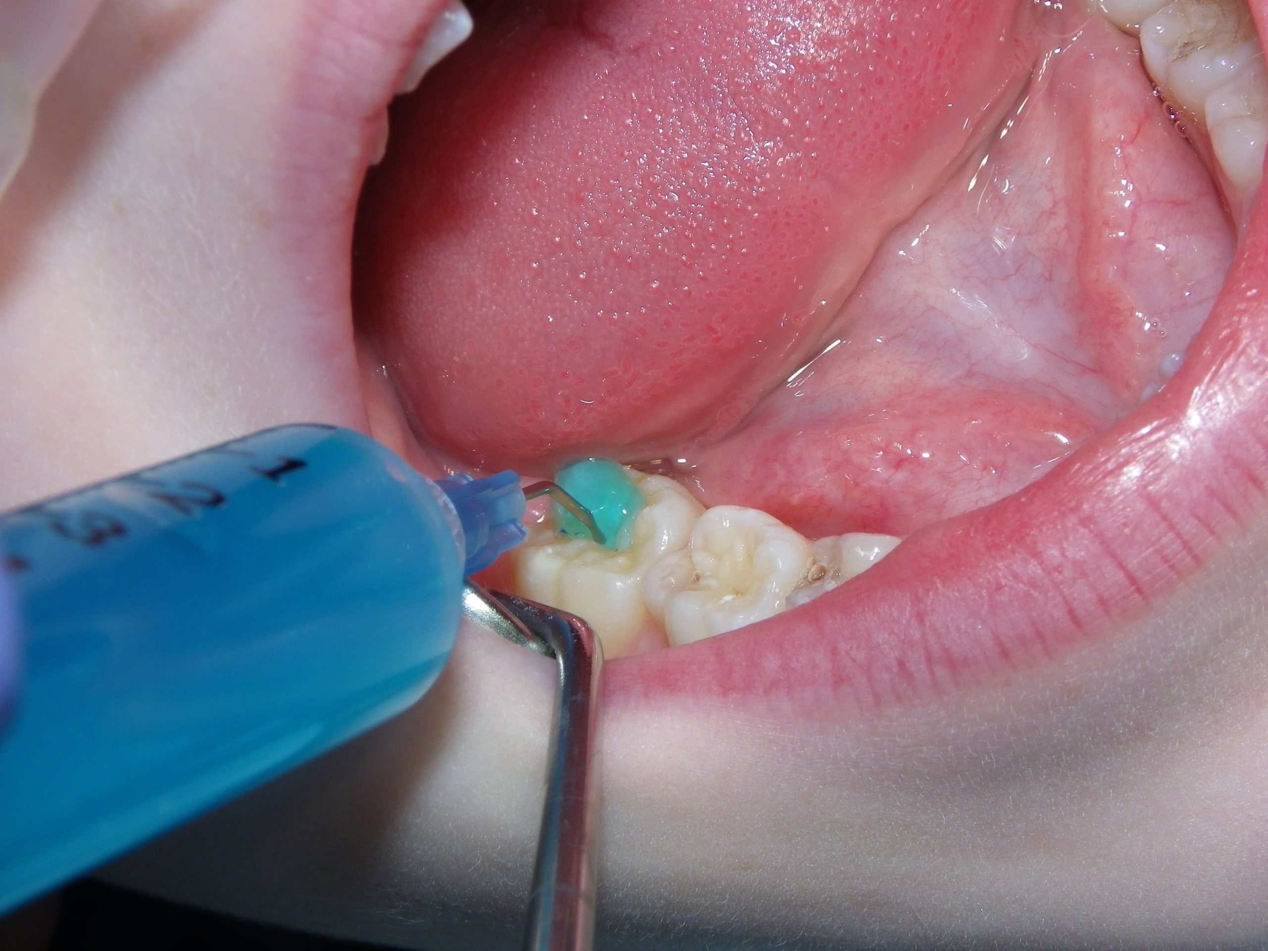 Tooth surface being polished during dental procedure
